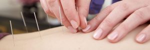 Inserting acupuncture needles