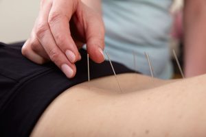 Acupuncture needles on the back