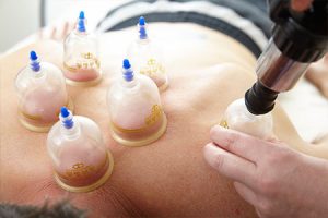 Cupping treatment by Katharine