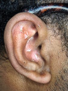 Ear of a black man with ear seeds